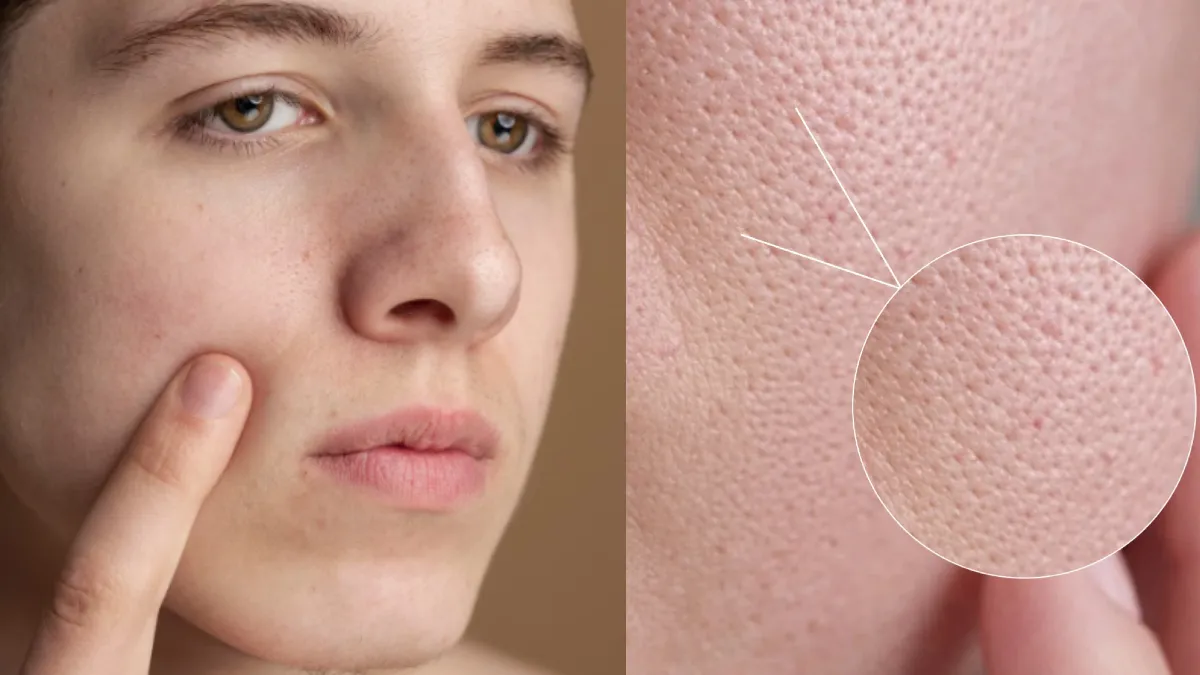 Open Pores on Face Treatment: Causes, Ayurvedic Remedies & Daily Skincare Routine