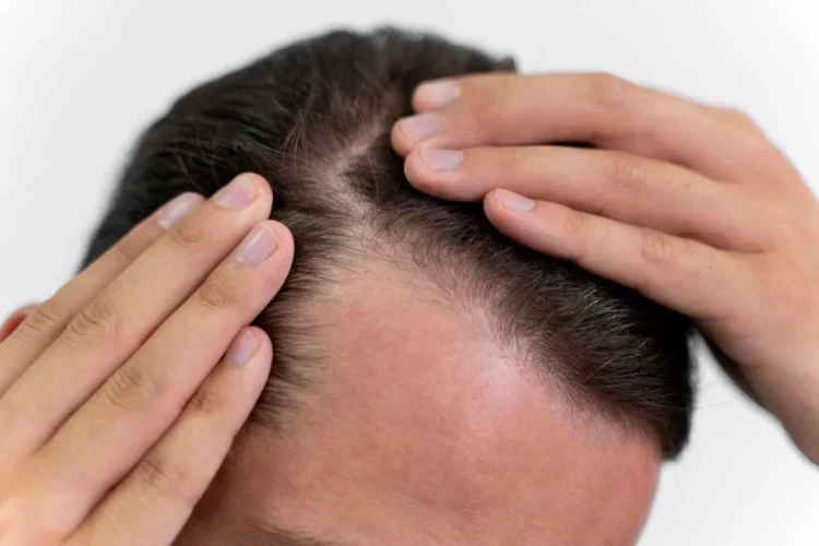How to Regrow Lost Hair on a Bald Spot or Receding Hairline: Beyond Quick Fixes