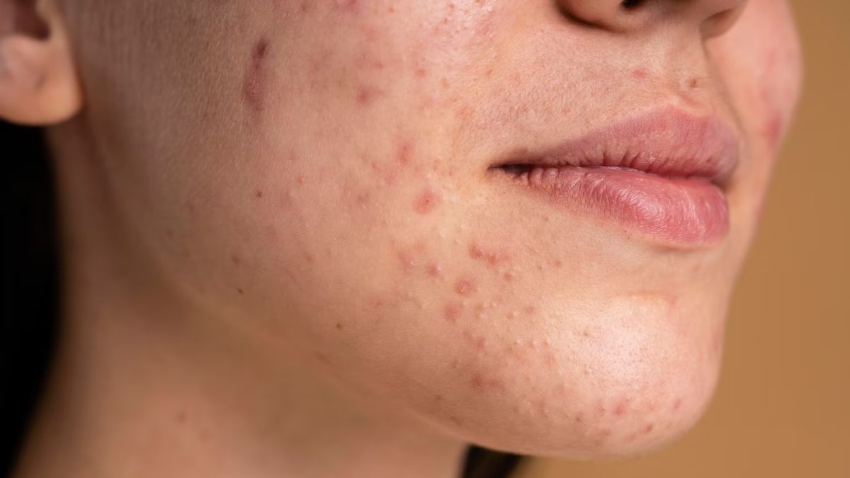 How to Remove Dark Spots on Face Naturally: Effective Remedies for Indian Skin