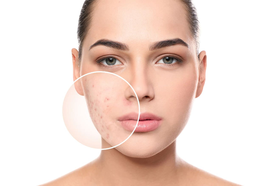 How to Remove Pimples and Acne Marks Fast: The Ultimate Science-Backed Guide for Indian Skin